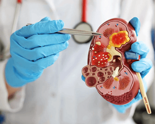 Acute Kidney Injury