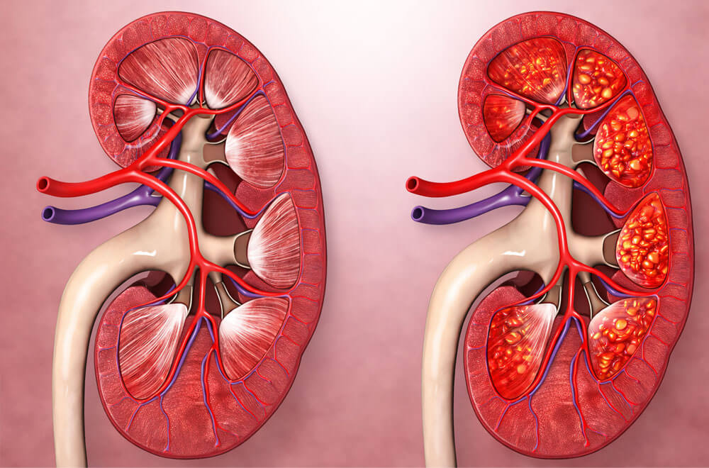 Glomerulonephritis and Lupus Nephritis Treatment