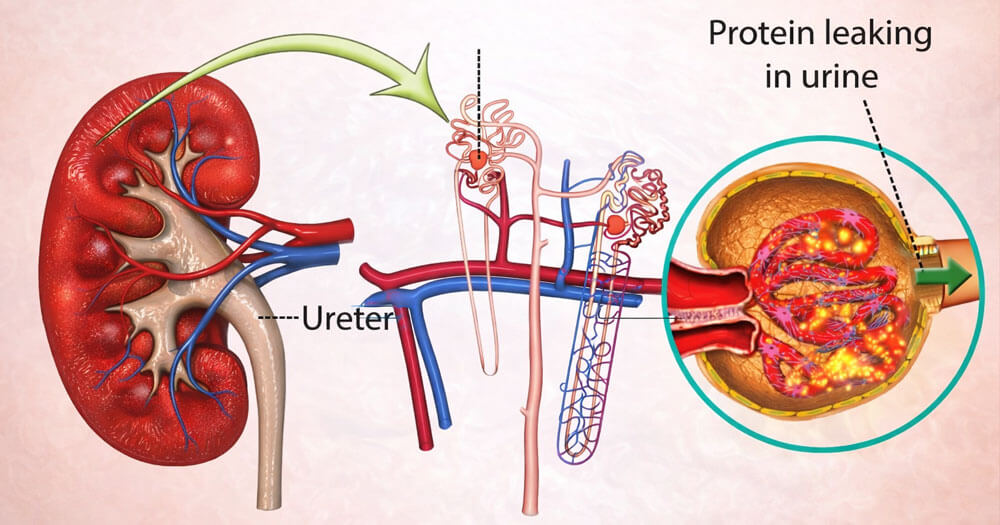 Nephrotic Syndrome Treatment